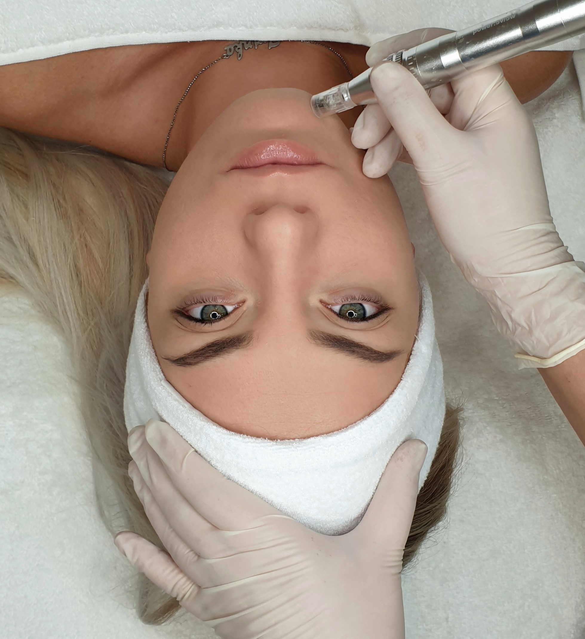 Dermapen treatment being done on a woman