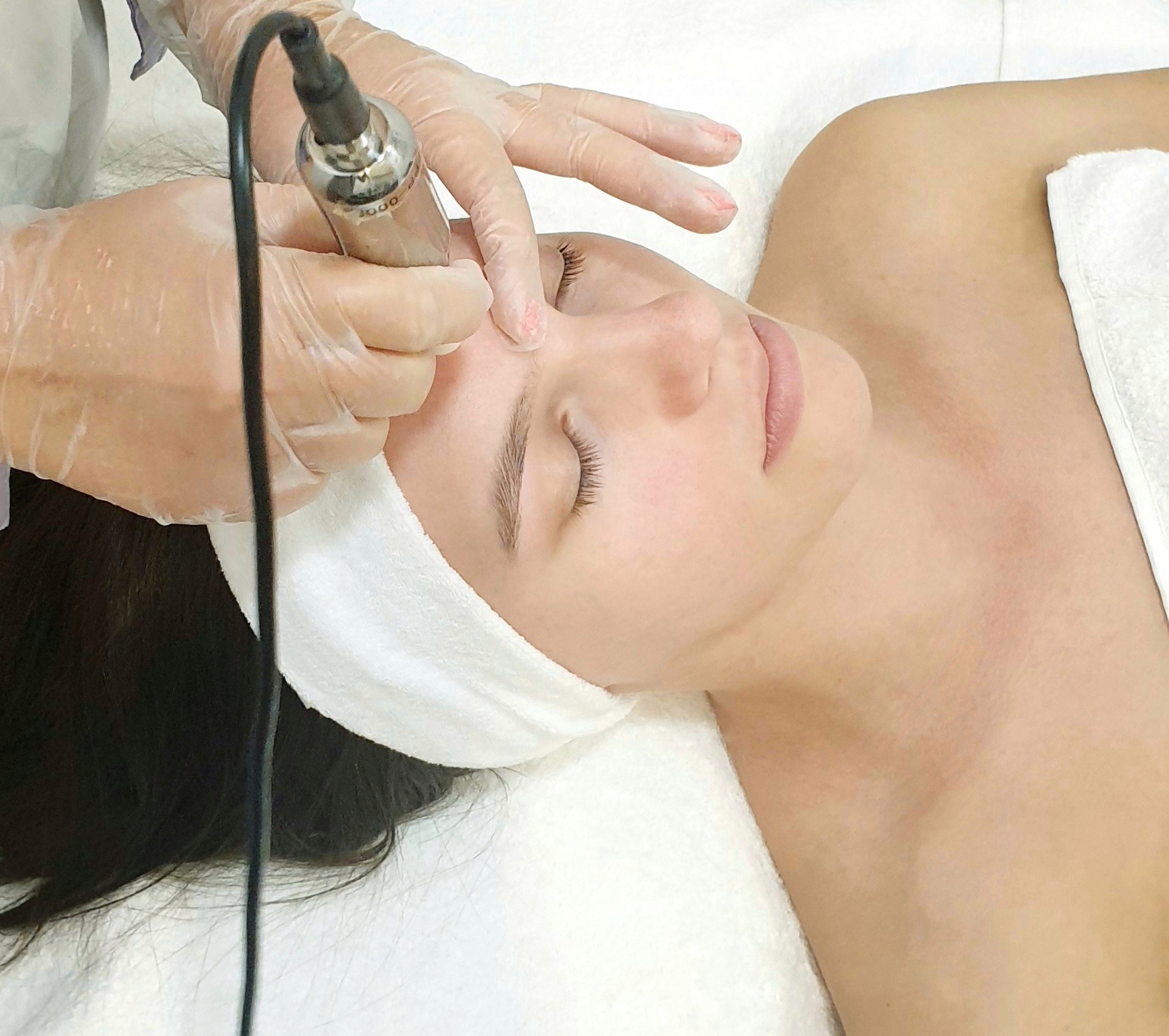 Dermoabrasion treatment being done on a woman